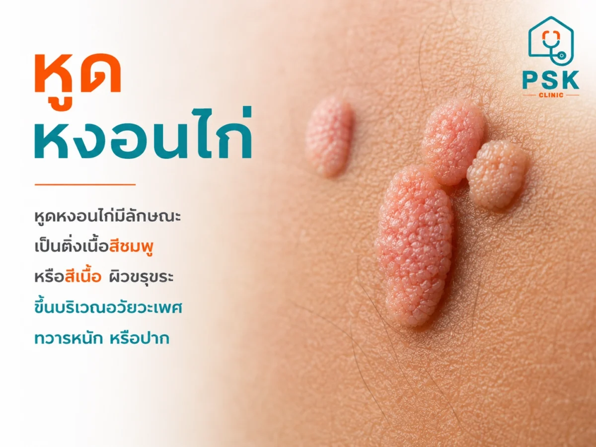 รูปหูดหงอนไก่พร้อมคำอธิบายลักษณะ